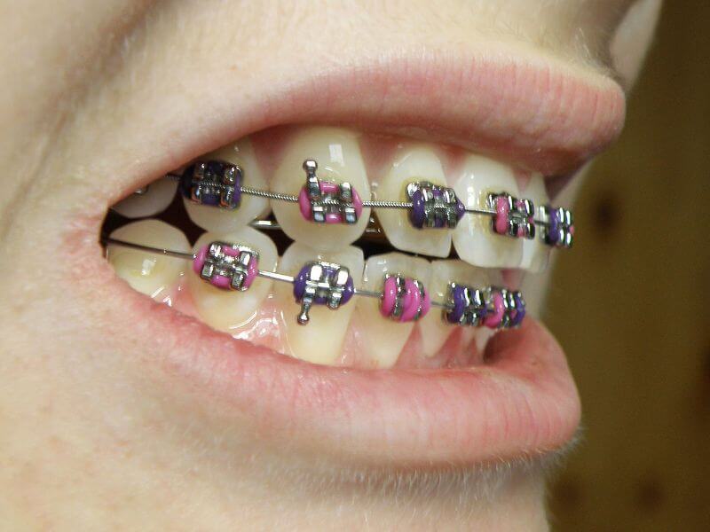 Braces - Alignment of Teeth