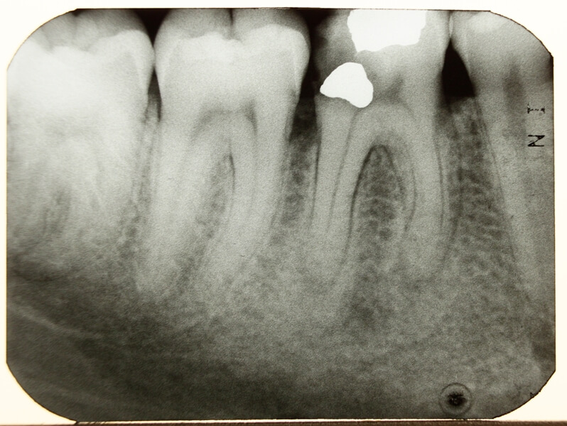 Dental XRay