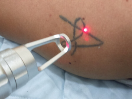 Laser Tattoo Removal in Siliguri