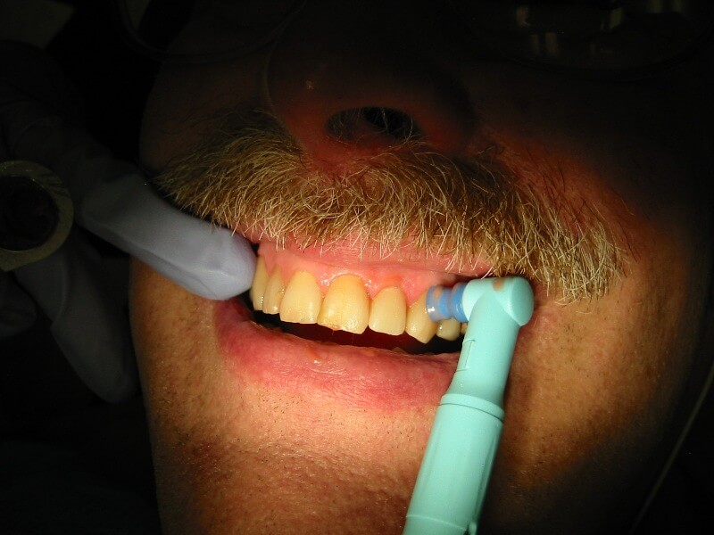 teeth-cleaning-in-siliguri-scaling-polishing-of-teeth-dr-agarwal