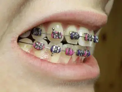 Braces