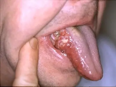 Oral Cancer