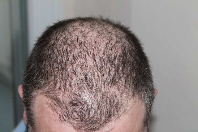 12 FAQs on Hair Loss on Google